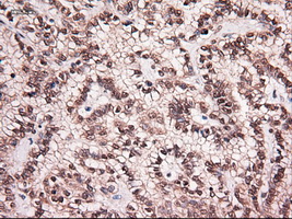 NTF4 / Neurotrophin 4 Antibody - Immunohistochemical staining of paraffin-embedded Carcinoma of kidney using anti-NTF4 mouse monoclonal antibody.