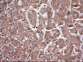 NTF4 / Neurotrophin 4 Antibody - Immunohistochemical staining of paraffin-embedded Carcinoma of liver using anti-NTF4 mouse monoclonal antibody.
