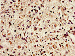 NTHL1 Antibody - Immunohistochemistry image of paraffin-embedded human glioma cancer at a dilution of 1:100