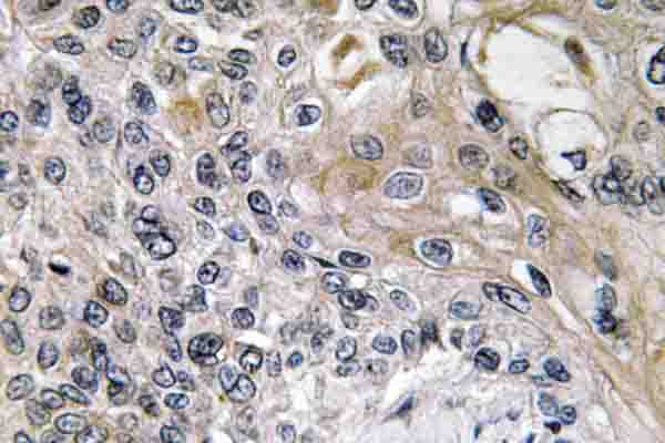 NTN1 / Netrin 1 Antibody - IHC of Netrin-1 (Q533) pAb in paraffin-embedded human lung carcinoma tissue.