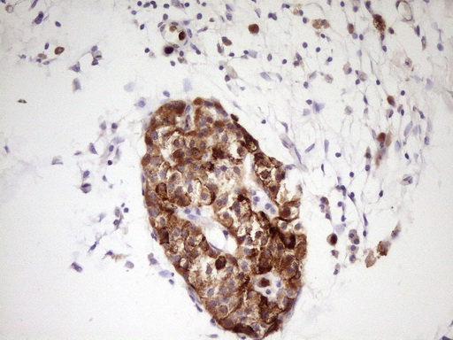 NTRK1 / TrkA Antibody - Immunohistochemical staining of paraffin-embedded Carcinoma of Human pancreas tissue using anti-NTRK1 mouse monoclonal antibody. (Heat-induced epitope retrieval by 1 mM EDTA in 10mM Tris, pH8.5, 120C for 3min,