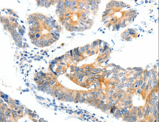 NTRK1 / TrkA Antibody - Immunohistochemistry of paraffin-embedded Human ovarian cancer using NTRK1 Polyclonal Antibody at dilution of 1:90.