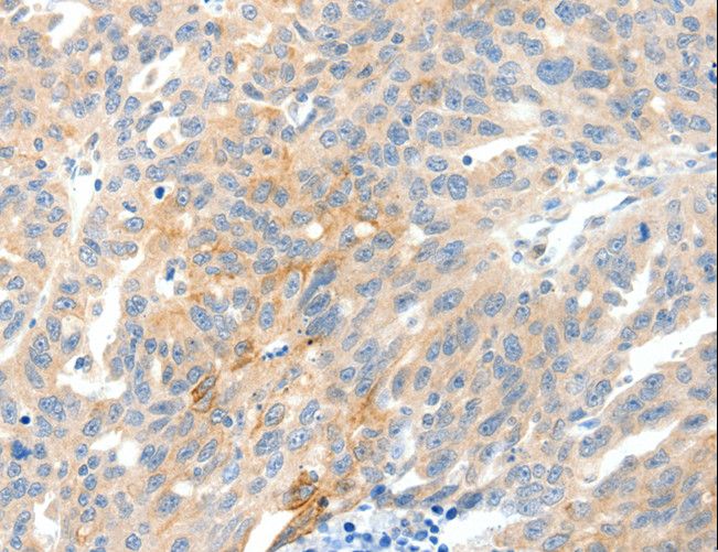 NTRK1 / TrkA Antibody - Immunohistochemistry of paraffin-embedded Human ovarian cancer using NTRK1 Polyclonal Antibody at dilution of 1:90.