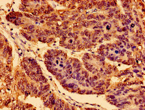 NTRK1 / TrkA Antibody - Immunohistochemistry image of paraffin-embedded human gastric cancer at a dilution of 1:100