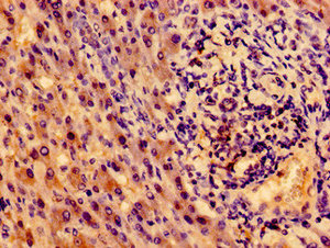 NTRK1 / TrkA Antibody - Immunohistochemistry image of paraffin-embedded human liver cancer at a dilution of 1:100