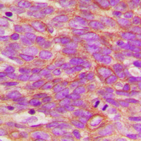 NTRK1 / TrkA Antibody - Immunohistochemical analysis of TRK A (pY496) staining in human breast cancer formalin fixed paraffin embedded tissue section. The section was pre-treated using heat mediated antigen retrieval with sodium citrate buffer (pH 6.0). The section was then incubated with the antibody at room temperature and detected using an HRP conjugated compact polymer system. DAB was used as the chromogen. The section was then counterstained with hematoxylin and mounted with DPX.