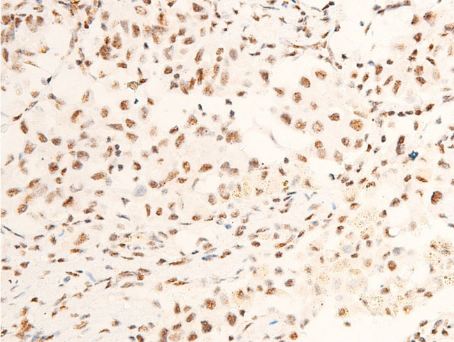 NTRK1 / TrkA Antibody - 1:100 staining human lung carcinoma tissue by IHC-P. The tissue was formaldehyde fixed and a heat mediated antigen retrieval step in citrate buffer was performed. The tissue was then blocked and incubated with the antibody for 1.5 hours at 22°C. An HRP conjugated goat anti-rabbit antibody was used as the secondary.