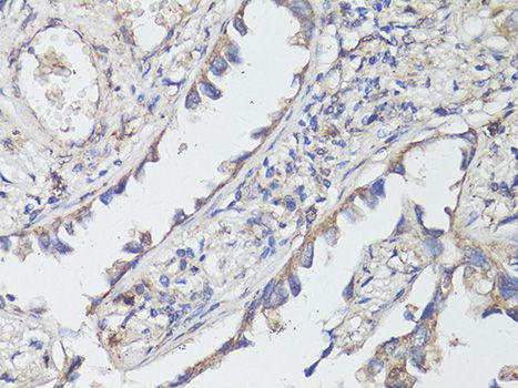 NTRK2 / TRKB Antibody - Immunohistochemistry of paraffin-embedded human lung cancer using NTRK2 antibody at dilution of 1:200 (40x lens).