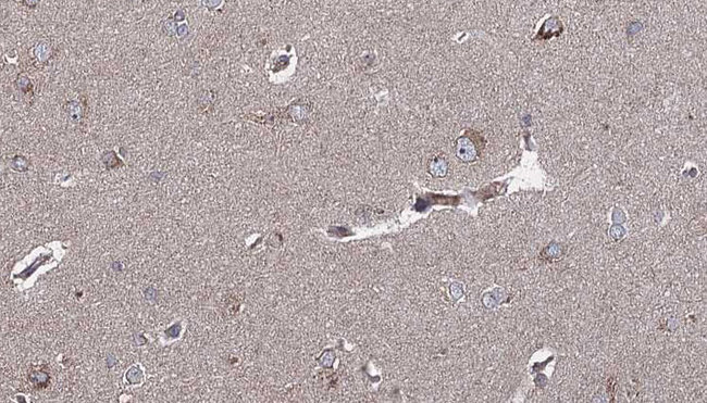NTRK2 / TRKB Antibody - 1:100 staining human brain carcinoma tissue by IHC-P. The sample was formaldehyde fixed and a heat mediated antigen retrieval step in citrate buffer was performed. The sample was then blocked and incubated with the antibody for 1.5 hours at 22°C. An HRP conjugated goat anti-rabbit antibody was used as the secondary.