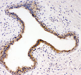 NTRK3 / TRKC Antibody - NTRK3 / TRKC antibody. IHC(P): Human Breast Cancer Tissue.