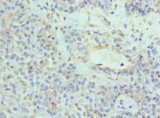 NTRK3 / TRKC Antibody - Immunohistochemistry of paraffin-embedded human breast cancer using antibody at 1:100 dilution.