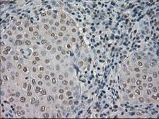 NTRK3 / TRKC Antibody - IHC of paraffin-embedded Adenocarcinoma of breast tissue using anti-NTRK3 mouse monoclonal antibody. (Dilution 1:50).