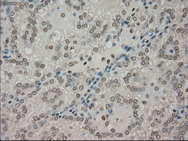 NTRK3 / TRKC Antibody - IHC of paraffin-embedded Carcinoma of kidney tissue using anti-NTRK3 mouse monoclonal antibody. (Dilution 1:50).
