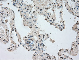 NTRK3 / TRKC Antibody - IHC of paraffin-embedded Carcinoma of lung tissue using anti-NTRK3 mouse monoclonal antibody. (Dilution 1:50).