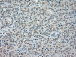 NTRK3 / TRKC Antibody - IHC of paraffin-embedded Carcinoma of thyroid tissue using anti-NTRK3 mouse monoclonal antibody. (Dilution 1:50).