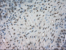 NTRK3 / TRKC Antibody - IHC of paraffin-embedded Adenocarcinoma of ovary tissue using anti-NTRK3 mouse monoclonal antibody. (Dilution 1:50).