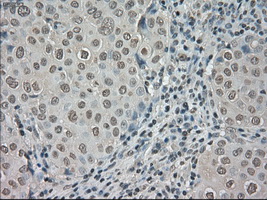 NTRK3 / TRKC Antibody - Immunohistochemical staining of paraffin-embedded Adenocarcinoma of breast tissue using anti-NTRK3 mouse monoclonal antibody. (Dilution 1:50).