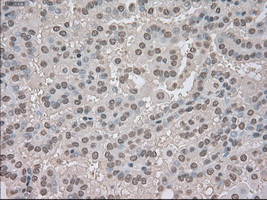 NTRK3 / TRKC Antibody - Immunohistochemical staining of paraffin-embedded Carcinoma of kidney tissue using anti-NTRK3 mouse monoclonal antibody. (Dilution 1:50).