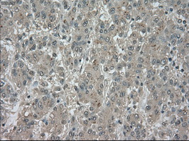 NTRK3 / TRKC Antibody - Immunohistochemical staining of paraffin-embedded Carcinoma of liver tissue using anti-NTRK3 mouse monoclonal antibody. (Dilution 1:50).