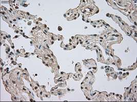 NTRK3 / TRKC Antibody - Immunohistochemical staining of paraffin-embedded Carcinoma of lung tissue using anti-NTRK3 mouse monoclonal antibody. (Dilution 1:50).