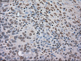 NTRK3 / TRKC Antibody - Immunohistochemical staining of paraffin-embedded Adenocarcinoma of ovary tissue using anti-NTRK3 mouse monoclonal antibody. (Dilution 1:50).