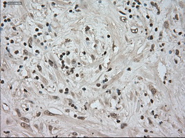 NTRK3 / TRKC Antibody - Immunohistochemical staining of paraffin-embedded Carcinoma of pancreas tissue using anti-NTRK3 mouse monoclonal antibody. (Dilution 1:50).