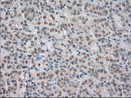 NTRK3 / TRKC Antibody - Immunohistochemical staining of paraffin-embedded Carcinoma of thyroid tissue using anti-NTRK3 mouse monoclonal antibody. (Dilution 1:50).