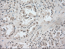 NTRK3 / TRKC Antibody - Immunohistochemical staining of paraffin-embedded Carcinoma of prostate tissue using anti-NTRK3 mouse monoclonal antibody. (Dilution 1:50).