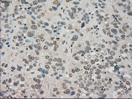 NTRK3 / TRKC Antibody - Immunohistochemical staining of paraffin-embedded Carcinoma of bladder tissue using anti-NTRK3 mouse monoclonal antibody. (Dilution 1:50).
