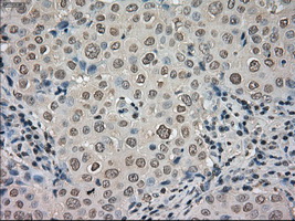 NTRK3 / TRKC Antibody - IHC of paraffin-embedded Adenocarcinoma of breast tissue using anti-NTRK3 mouse monoclonal antibody. (Dilution 1:50).