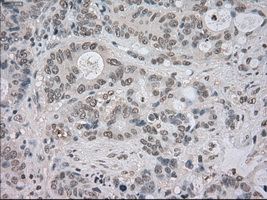 NTRK3 / TRKC Antibody - IHC of paraffin-embedded Adenocarcinoma of colon tissue using anti-NTRK3 mouse monoclonal antibody. (Dilution 1:50).