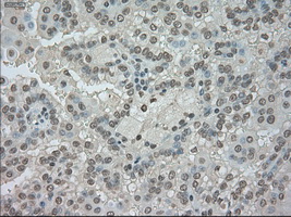 NTRK3 / TRKC Antibody - IHC of paraffin-embedded Carcinoma of kidney tissue using anti-NTRK3 mouse monoclonal antibody. (Dilution 1:50).