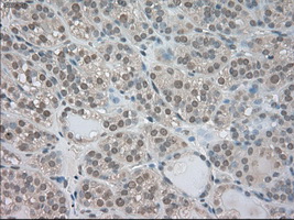 NTRK3 / TRKC Antibody - IHC of paraffin-embedded Carcinoma of thyroid tissue using anti-NTRK3 mouse monoclonal antibody. (Dilution 1:50).