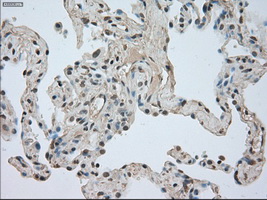 NTRK3 / TRKC Antibody - IHC of paraffin-embedded Carcinoma of lung tissue using anti-NTRK3 mouse monoclonal antibody. (Dilution 1:50).