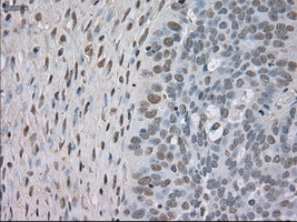 NTRK3 / TRKC Antibody - IHC of paraffin-embedded Adenocarcinoma of ovary tissue using anti-NTRK3 mouse monoclonal antibody. (Dilution 1:50).