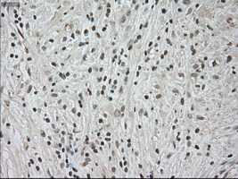 NTRK3 / TRKC Antibody - IHC of paraffin-embedded Carcinoma of pancreas tissue using anti-NTRK3 mouse monoclonal antibody. (Dilution 1:50).