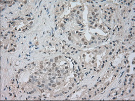 NTRK3 / TRKC Antibody - IHC of paraffin-embedded Carcinoma of prostate tissue using anti-NTRK3 mouse monoclonal antibody. (Dilution 1:50).