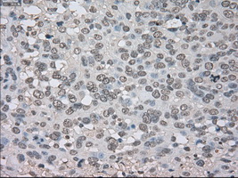 NTRK3 / TRKC Antibody - IHC of paraffin-embedded Carcinoma of bladder tissue using anti-NTRK3 mouse monoclonal antibody. (Dilution 1:50).