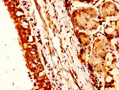 NTS / NT / Neurotensin Antibody - IHC image of NTS Antibody diluted at 1:300 and staining in paraffin-embedded human lung cancer performed on a Leica BondTM system. After dewaxing and hydration, antigen retrieval was mediated by high pressure in a citrate buffer (pH 6.0). Section was blocked with 10% normal goat serum 30min at RT. Then primary antibody (1% BSA) was incubated at 4°C overnight. The primary is detected by a biotinylated secondary antibody and visualized using an HRP conjugated SP system.
