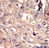 NUAK1 / ARK5 Antibody - Formalin-fixed and paraffin-embedded human cancer tissue reacted with the primary antibody, which was peroxidase-conjugated to the secondary antibody, followed by AEC staining. This data demonstrates the use of this antibody for immunohistochemistry; clinical relevance has not been evaluated. BC = breast carcinoma; HC = hepatocarcinoma.