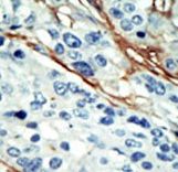 NUAK1 / ARK5 Antibody - Formalin-fixed and paraffin-embedded human cancer tissue reacted with the primary antibody, which was peroxidase-conjugated to the secondary antibody, followed by DAB staining. This data demonstrates the use of this antibody for immunohistochemistry; clinical relevance has not been evaluated. BC = breast carcinoma; HC = hepatocarcinoma.