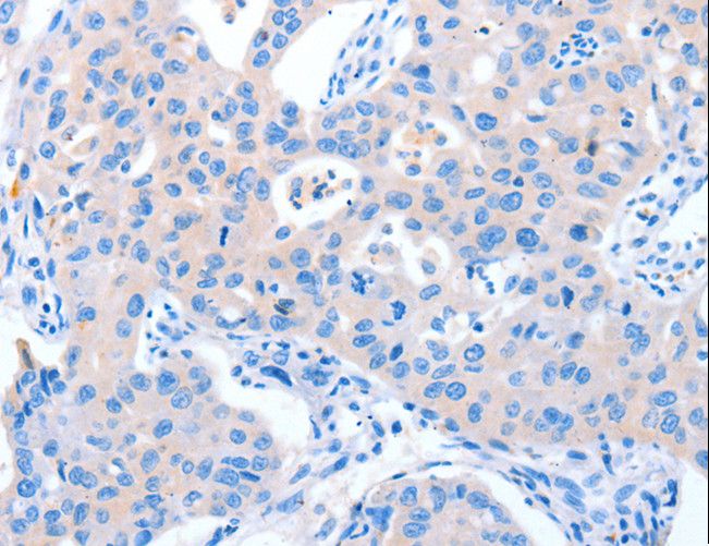 NUAK1 / ARK5 Antibody - Immunohistochemistry of paraffin-embedded Human lung cancer using NUAK1 Polyclonal Antibody at dilution of 1:60.