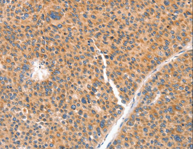 NUAK1 / ARK5 Antibody - Immunohistochemistry of paraffin-embedded Human liver cancer using NUAK1 Polyclonal Antibody at dilution of 1:70.