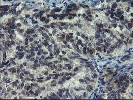 NUB1 Antibody - IHC of paraffin-embedded Adenocarcinoma of Human ovary tissue using anti-NUB1 mouse monoclonal antibody.