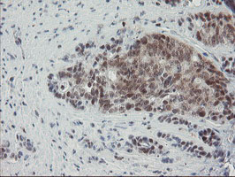 NUB1 Antibody - IHC of paraffin-embedded Carcinoma of Human pancreas tissue using anti-NUB1 mouse monoclonal antibody.