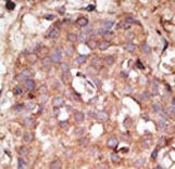 NUB1 Antibody - Formalin-fixed and paraffin-embedded human cancer tissue reacted with the primary antibody, which was peroxidase-conjugated to the secondary antibody, followed by DAB staining. This data demonstrates the use of this antibody for immunohistochemistry; clinical relevance has not been evaluated. BC = breast carcinoma; HC = hepatocarcinoma.