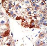 NUB1 Antibody - Formalin-fixed and paraffin-embedded human cancer tissue reacted with the primary antibody, which was peroxidase-conjugated to the secondary antibody, followed by DAB staining. This data demonstrates the use of this antibody for immunohistochemistry; clinical relevance has not been evaluated. BC = breast carcinoma; HC = hepatocarcinoma.