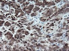 NUB1 Antibody - IHC of paraffin-embedded Adenocarcinoma of Human ovary tissue using anti-NUB1 mouse monoclonal antibody.