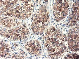 NUBPL Antibody - IHC of paraffin-embedded Carcinoma of Human liver tissue using anti-NUBPL mouse monoclonal antibody. (Heat-induced epitope retrieval by 10mM citric buffer, pH6.0, 100C for 10min).