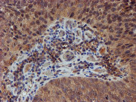 NUBPL Antibody - IHC of paraffin-embedded Carcinoma of Human bladder tissue using anti-NUBPL mouse monoclonal antibody. (Heat-induced epitope retrieval by 10mM citric buffer, pH6.0, 100C for 10min).